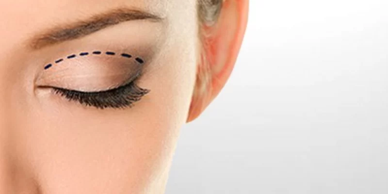Operation des unteren und oberen Augenlids